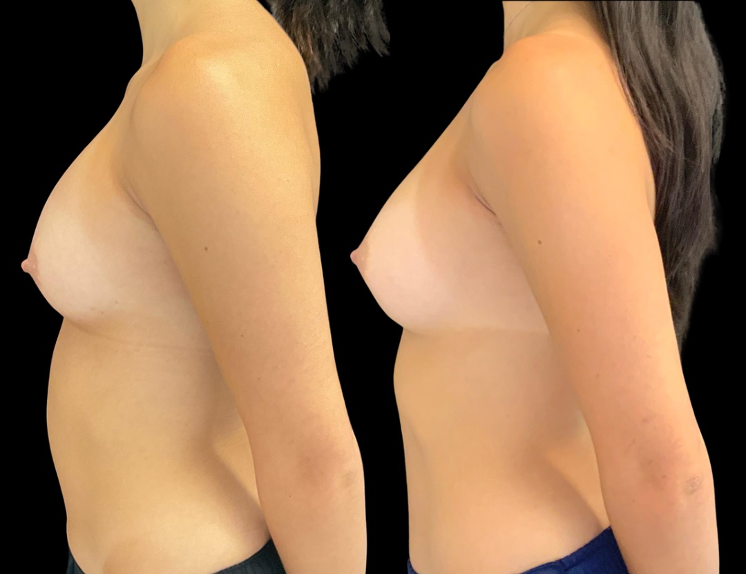 Copy of 37547 rhinoplasty male before and after – 3